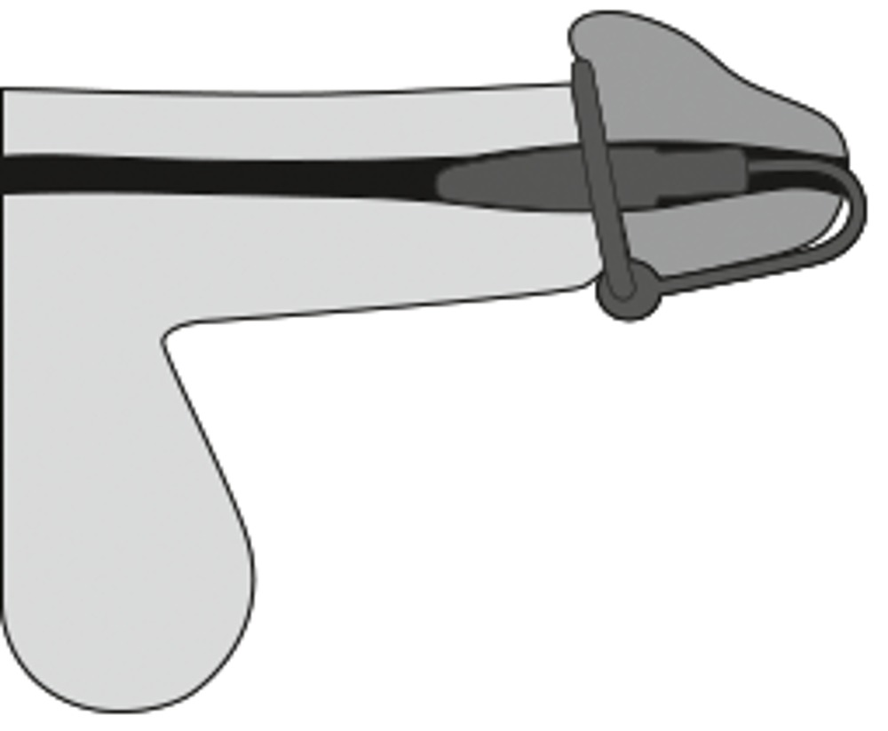 Dilator z pierścieniem — zdjęcie 7