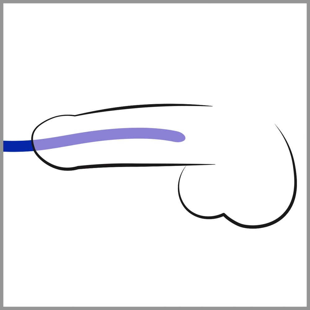 Komplet silikonowych dilatorów — zdjęcie 3